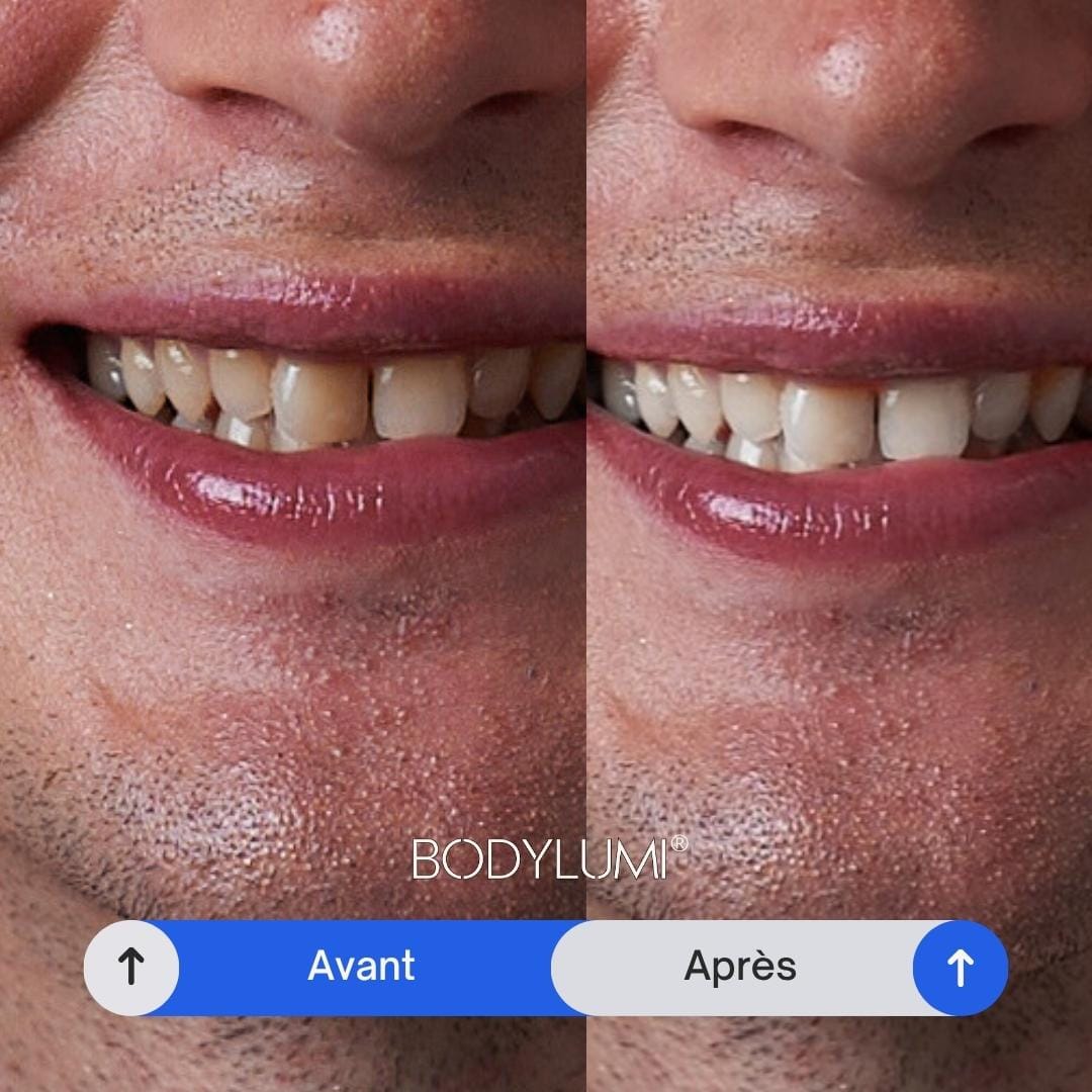 Avant après - Dents blanches ultra white