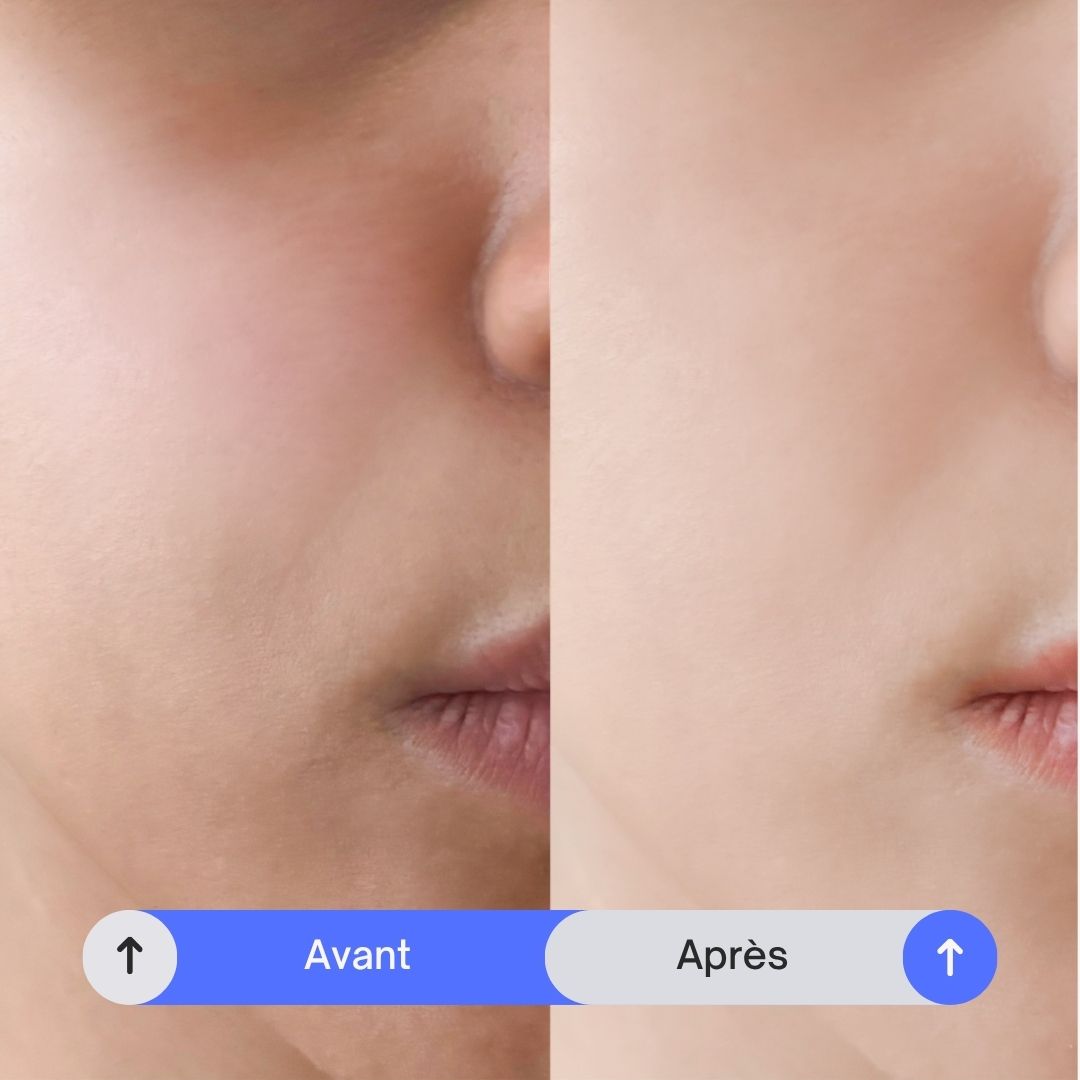 Avant Après peeling profond et doux pour une peau saine, sans acné et lumineuse